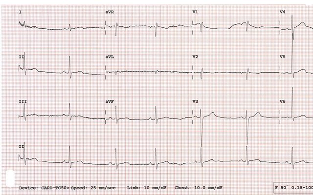 electrocardiograma